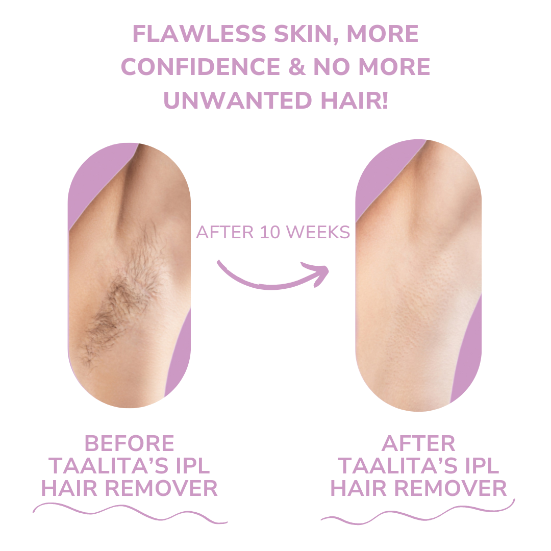 S IPL Hair Remover I The leading laser hair removal for your home